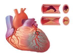 Sơ cứu người bị nhồi máu cơ tim tại nhà