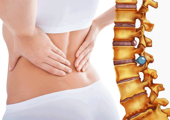 Thoát vị đĩa đệm là gì? Triệu chứng, nguyên nhân, cách khắc phục