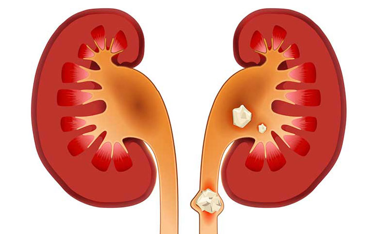 Phát hiện dấu hiệu sỏi thận, cần làm gì?