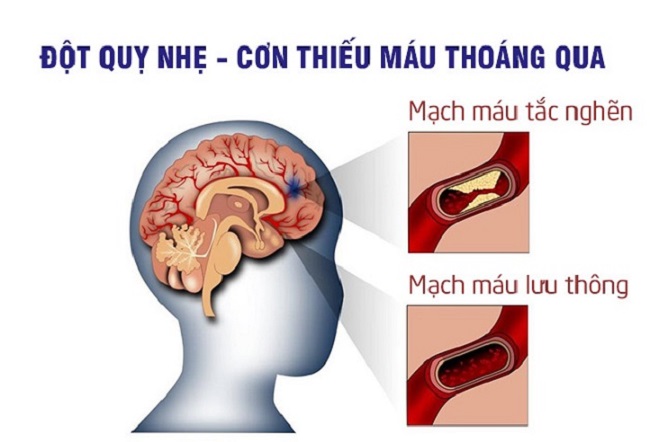 thieu mau thoang qua tt