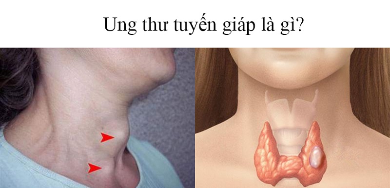 ung thu tuyen giap la gi