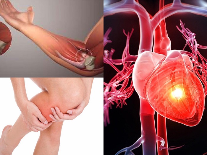 Đột ngột bị đau ch&acirc;n, tay, đau dữ dội - biểu hiện bệnh tim mạch cần cấp cứu