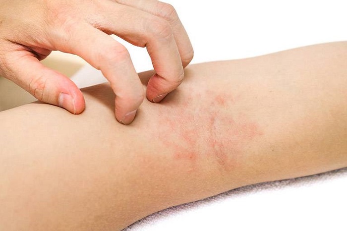 Bị viêm da cơ địa cần lưu ý gì?