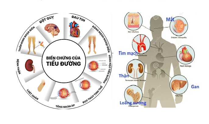 Biến chứng nhiễm trùng trên bệnh nhân đái tháo đường