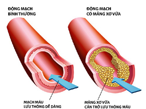 Những hệ lụy từ rối loạn mỡ máu