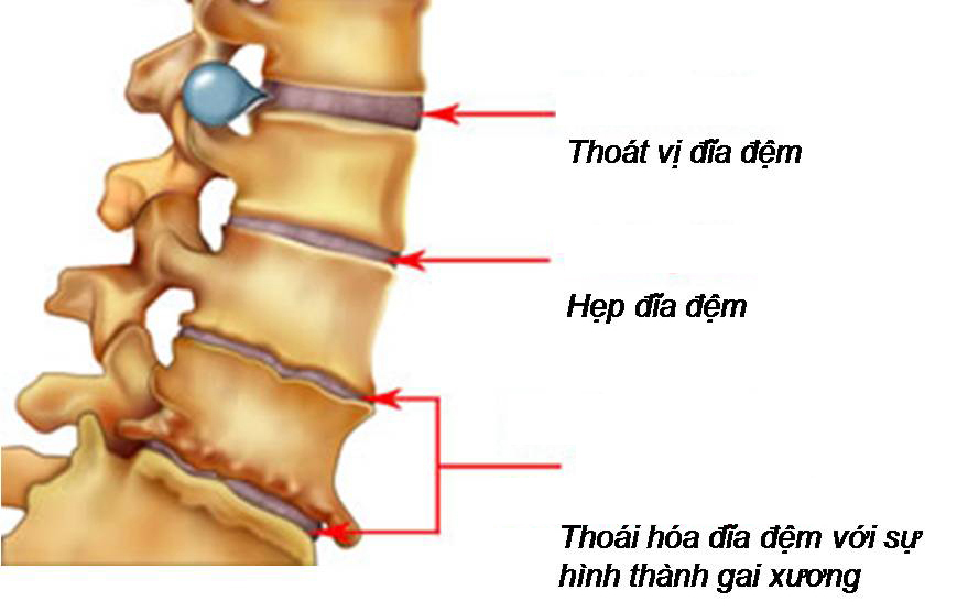 thoai hoa dia dem cot song that lung