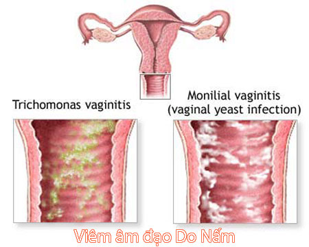 Những bệnh viêm nhiễm âm đạo thường gặp